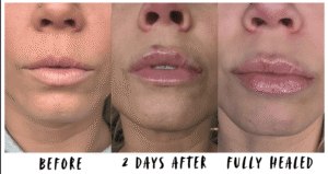 Lip filler results showing before treatment, two days after injection, and fully healed lips.
