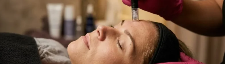 Professional microneedling collagen induction therapy performed by licensed provider at Express Med Spa