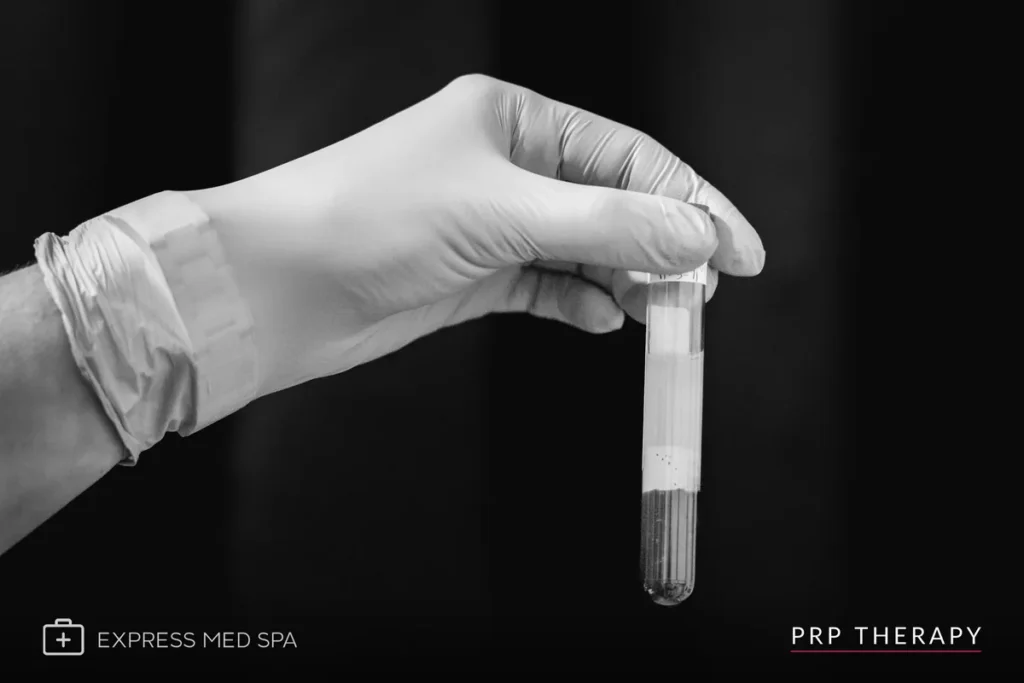 Professional microneedling treatment session with SkinPen device at Express Med Spa